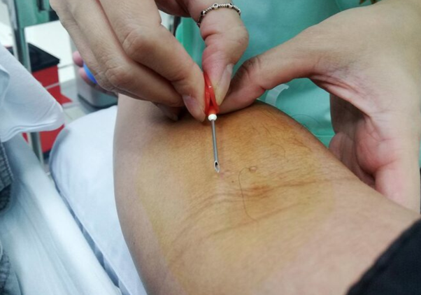 How To Successfully Get Keloid Removal Malaysia Treatments Done Right? How To Successfully Get Keloid Removal Malaysia Treatments Done Right?